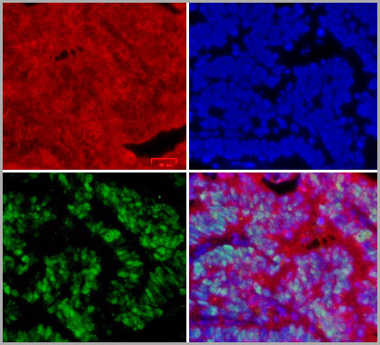 Human colon adenocarcinoma on paraffin – pretreated for heat-induced epitope retrieval (HIER) using Tris/EDTA pH 9 and blocked with 10% FCS – was stained with goat anti-stem cell factor (kit-ligand) antibody and donkey anti-sheep/goat IgG:DyLight 549 secondary antibody (red), mouse anti-p53 antibody and rabbit anti-mouse IgG:DyLight 488 secondary antibody (green), and DAPI (blue).