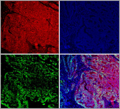 Human colon adenocarcinoma on paraffin – pretreated for heat-induced epitope retrieval (HIER) using Tris/EDTA pH 9 and blocked with 10% FCS – was stained with goat anti-stem cell factor (kit-ligand) antibody and donkey anti-sheep/goat IgG:DyLight 549 secondary antibody (red), mouse anti-p53 antibody and rabbit anti-mouse IgG:DyLight 488 secondary antibody (green), and DAPI (blue).